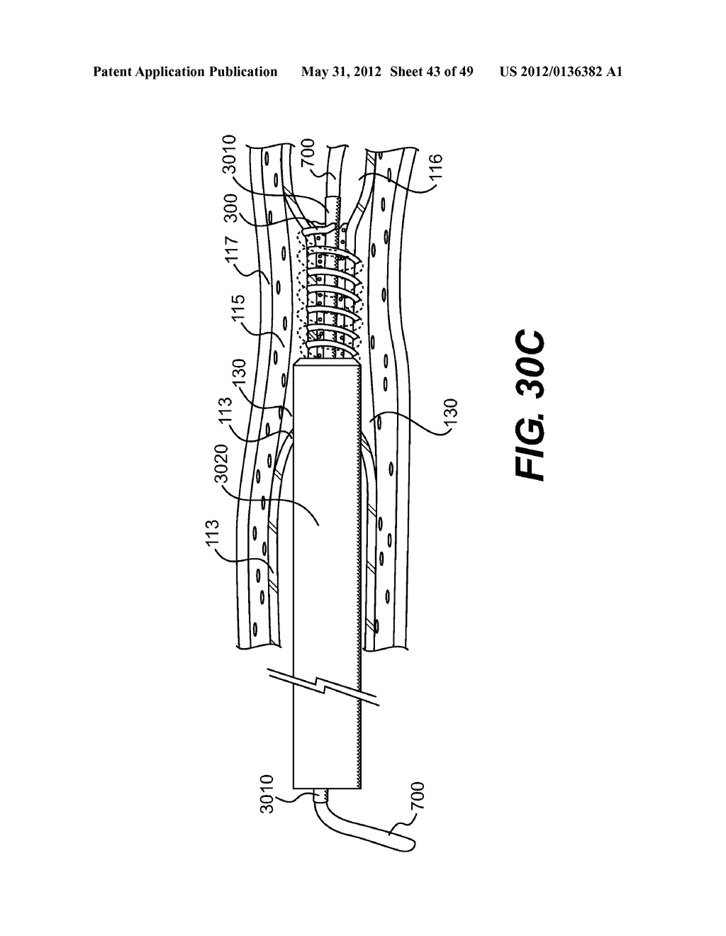 ENDOVASCULAR DEVICES AND METHODS FOR EXPLOITING INTRAMURAL SPACE - diagram, schematic, and image 44