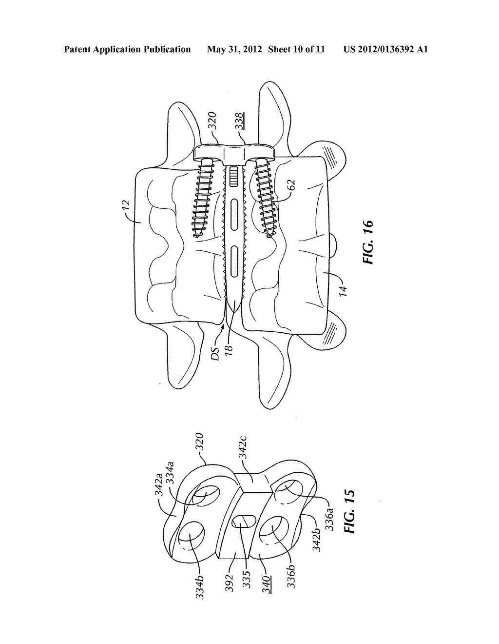 System and Method for Stabilizing Vertebrae in Spine Surgery Through a     Lateral Access Channel - diagram, schematic, and image 11