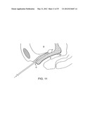 INCONTINENCE TREATMENT WITH URETHRAL GUIDE diagram and image