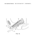 INCONTINENCE TREATMENT WITH URETHRAL GUIDE diagram and image