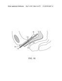 INCONTINENCE TREATMENT WITH URETHRAL GUIDE diagram and image