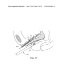 INCONTINENCE TREATMENT WITH URETHRAL GUIDE diagram and image