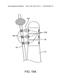 INCONTINENCE TREATMENT WITH URETHRAL GUIDE diagram and image