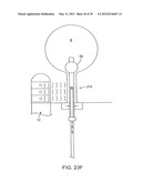 INCONTINENCE TREATMENT WITH URETHRAL GUIDE diagram and image