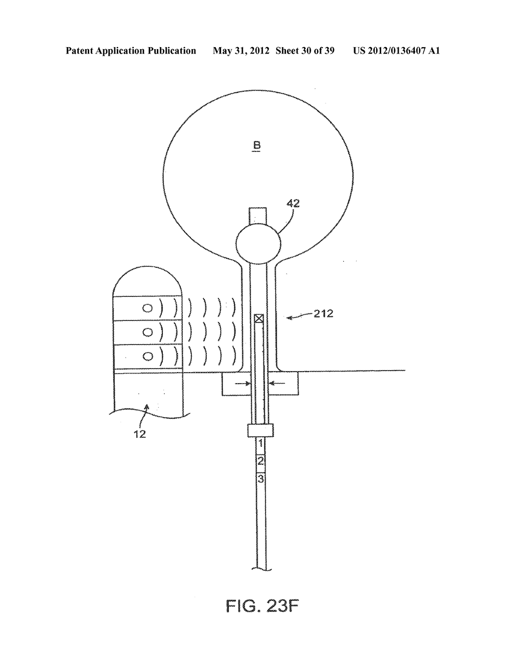 INCONTINENCE TREATMENT WITH URETHRAL GUIDE - diagram, schematic, and image 31