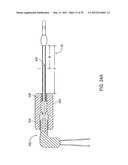 INCONTINENCE TREATMENT WITH URETHRAL GUIDE diagram and image