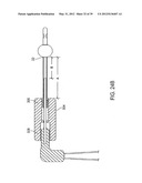 INCONTINENCE TREATMENT WITH URETHRAL GUIDE diagram and image