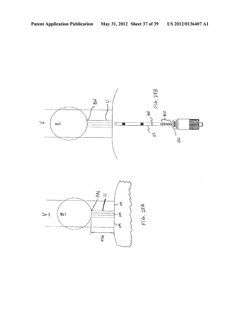 INCONTINENCE TREATMENT WITH URETHRAL GUIDE - diagram, schematic, and image 38