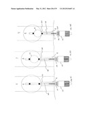 INCONTINENCE TREATMENT WITH URETHRAL GUIDE diagram and image