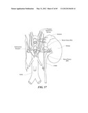 NEUROMODULATION CRYOTHERAPEUTIC DEVICES AND ASSOCIATED SYSTEMS AND METHODS diagram and image