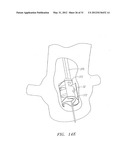 Prosthetic Heart Valves, Scaffolding Structures, and Systems and Methods     for Implantation of Same diagram and image