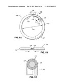 INTRAOPERATIVE AND POST-OPERATIVE ADJUSTMENT OF AN ANNULOPLASTY RING diagram and image