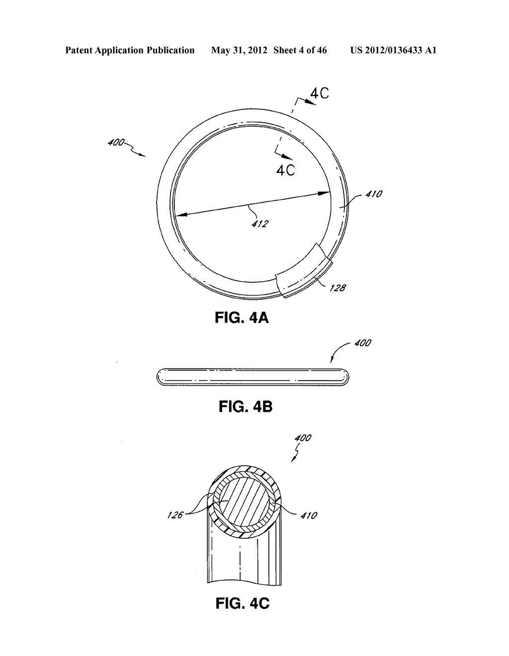 INTRAOPERATIVE AND POST-OPERATIVE ADJUSTMENT OF AN ANNULOPLASTY RING - diagram, schematic, and image 05