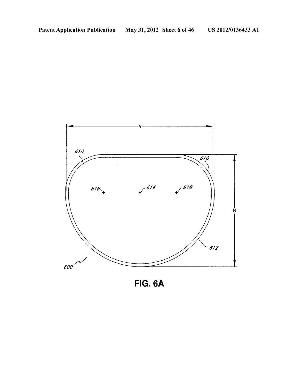 INTRAOPERATIVE AND POST-OPERATIVE ADJUSTMENT OF AN ANNULOPLASTY RING - diagram, schematic, and image 07