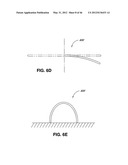 INTRAOPERATIVE AND POST-OPERATIVE ADJUSTMENT OF AN ANNULOPLASTY RING diagram and image