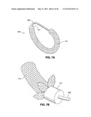 INTRAOPERATIVE AND POST-OPERATIVE ADJUSTMENT OF AN ANNULOPLASTY RING diagram and image