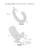 INTRAOPERATIVE AND POST-OPERATIVE ADJUSTMENT OF AN ANNULOPLASTY RING diagram and image