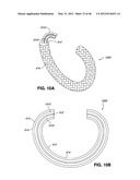 INTRAOPERATIVE AND POST-OPERATIVE ADJUSTMENT OF AN ANNULOPLASTY RING diagram and image