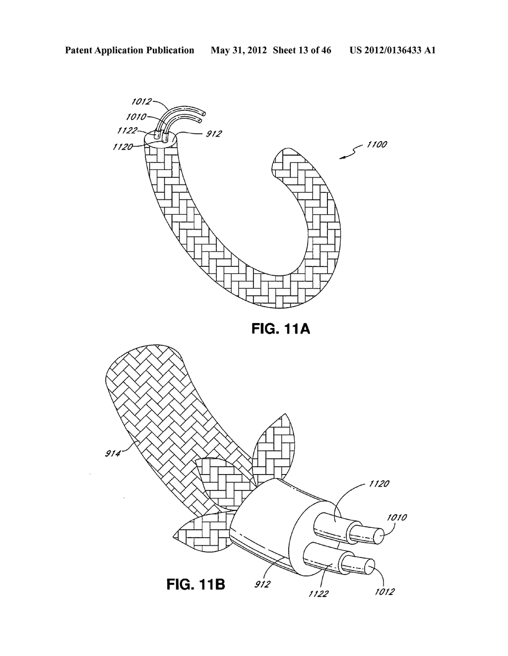 INTRAOPERATIVE AND POST-OPERATIVE ADJUSTMENT OF AN ANNULOPLASTY RING - diagram, schematic, and image 14