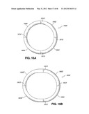 INTRAOPERATIVE AND POST-OPERATIVE ADJUSTMENT OF AN ANNULOPLASTY RING diagram and image