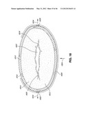 INTRAOPERATIVE AND POST-OPERATIVE ADJUSTMENT OF AN ANNULOPLASTY RING diagram and image