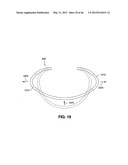 INTRAOPERATIVE AND POST-OPERATIVE ADJUSTMENT OF AN ANNULOPLASTY RING diagram and image