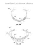 INTRAOPERATIVE AND POST-OPERATIVE ADJUSTMENT OF AN ANNULOPLASTY RING diagram and image