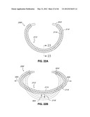 INTRAOPERATIVE AND POST-OPERATIVE ADJUSTMENT OF AN ANNULOPLASTY RING diagram and image