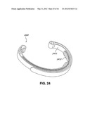 INTRAOPERATIVE AND POST-OPERATIVE ADJUSTMENT OF AN ANNULOPLASTY RING diagram and image