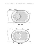 INTRAOPERATIVE AND POST-OPERATIVE ADJUSTMENT OF AN ANNULOPLASTY RING diagram and image