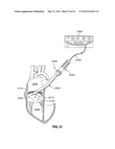 INTRAOPERATIVE AND POST-OPERATIVE ADJUSTMENT OF AN ANNULOPLASTY RING diagram and image