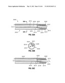 INTRAOPERATIVE AND POST-OPERATIVE ADJUSTMENT OF AN ANNULOPLASTY RING diagram and image