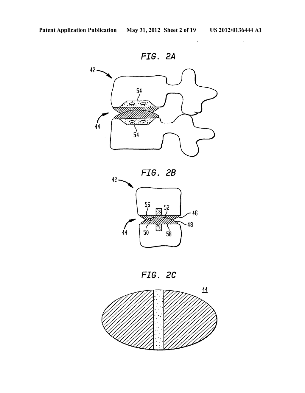 TWO-COMPONENT ARTIFICIAL DISC REPLACEMENTS - diagram, schematic, and image 03