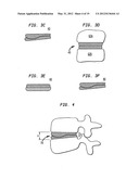 TWO-COMPONENT ARTIFICIAL DISC REPLACEMENTS diagram and image