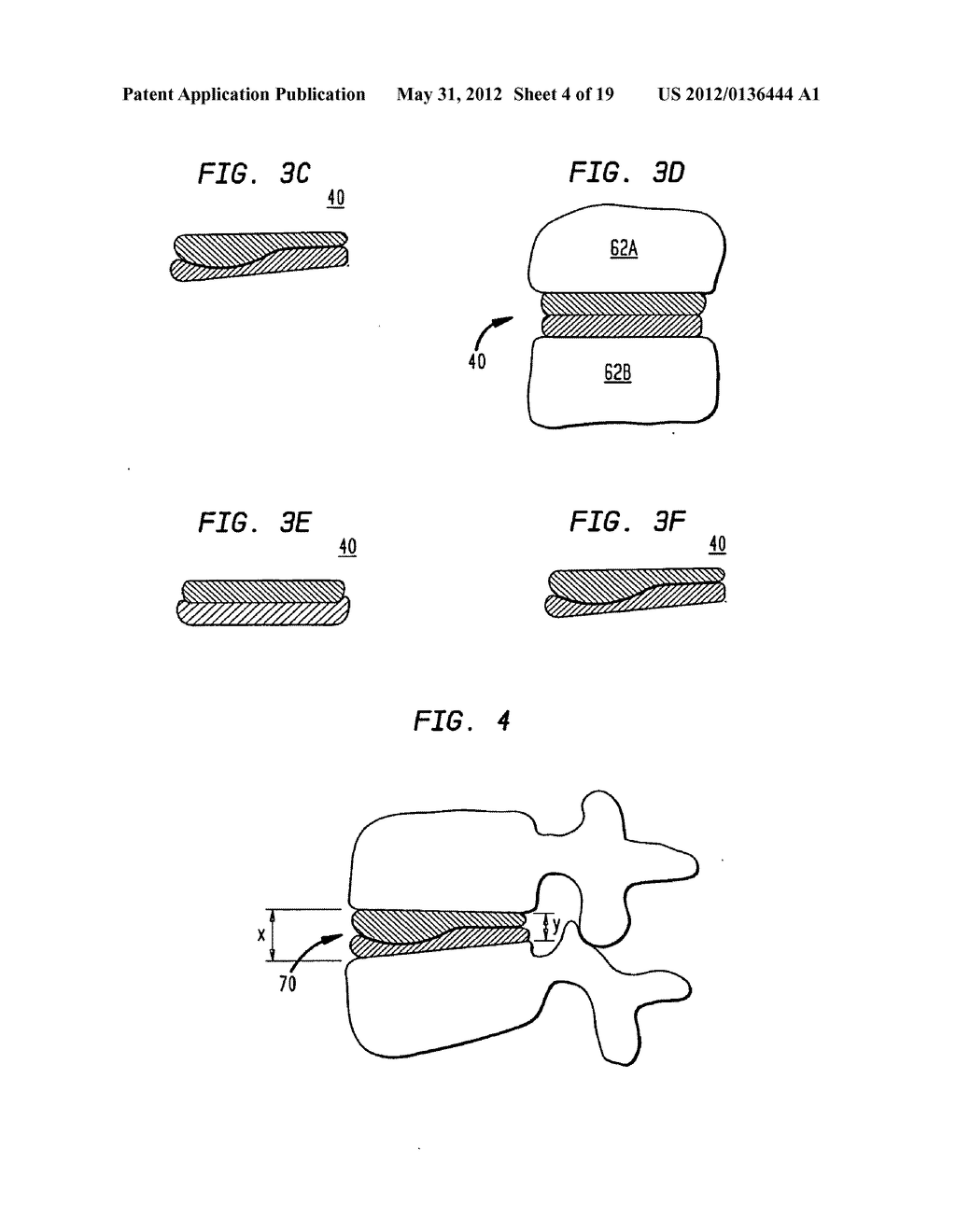 TWO-COMPONENT ARTIFICIAL DISC REPLACEMENTS - diagram, schematic, and image 05