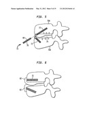 TWO-COMPONENT ARTIFICIAL DISC REPLACEMENTS diagram and image