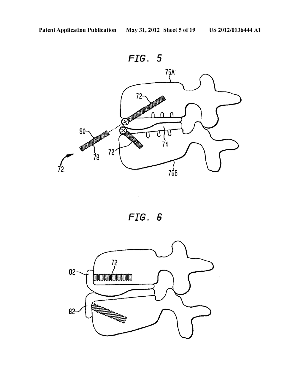 TWO-COMPONENT ARTIFICIAL DISC REPLACEMENTS - diagram, schematic, and image 06