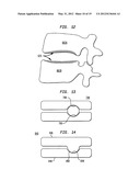 TWO-COMPONENT ARTIFICIAL DISC REPLACEMENTS diagram and image