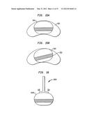 TWO-COMPONENT ARTIFICIAL DISC REPLACEMENTS diagram and image