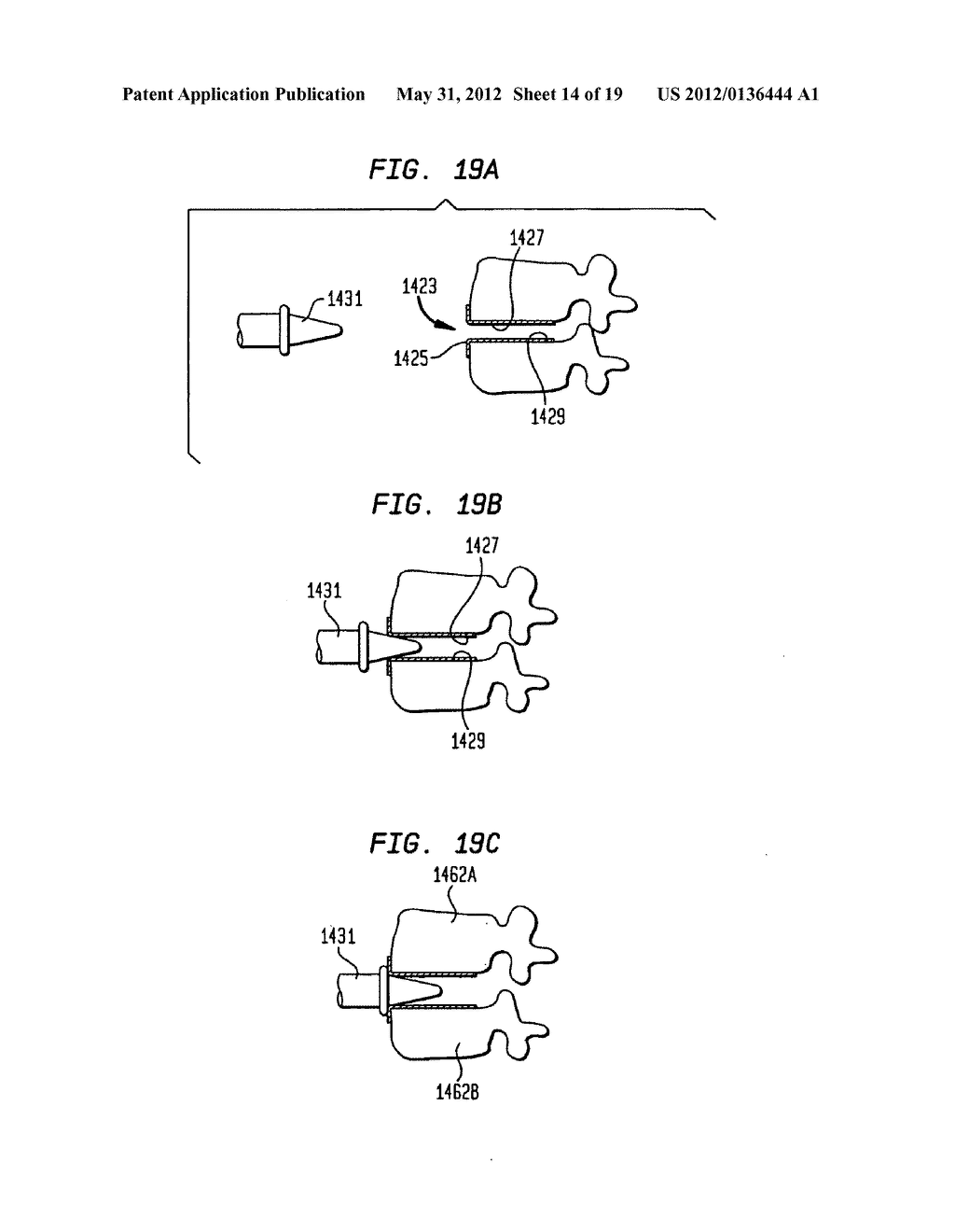 TWO-COMPONENT ARTIFICIAL DISC REPLACEMENTS - diagram, schematic, and image 15