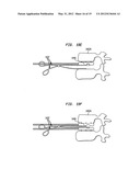 TWO-COMPONENT ARTIFICIAL DISC REPLACEMENTS diagram and image