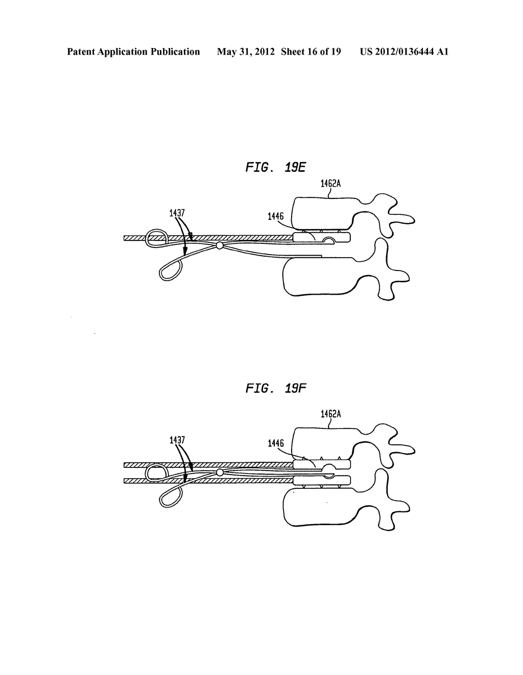 TWO-COMPONENT ARTIFICIAL DISC REPLACEMENTS - diagram, schematic, and image 17