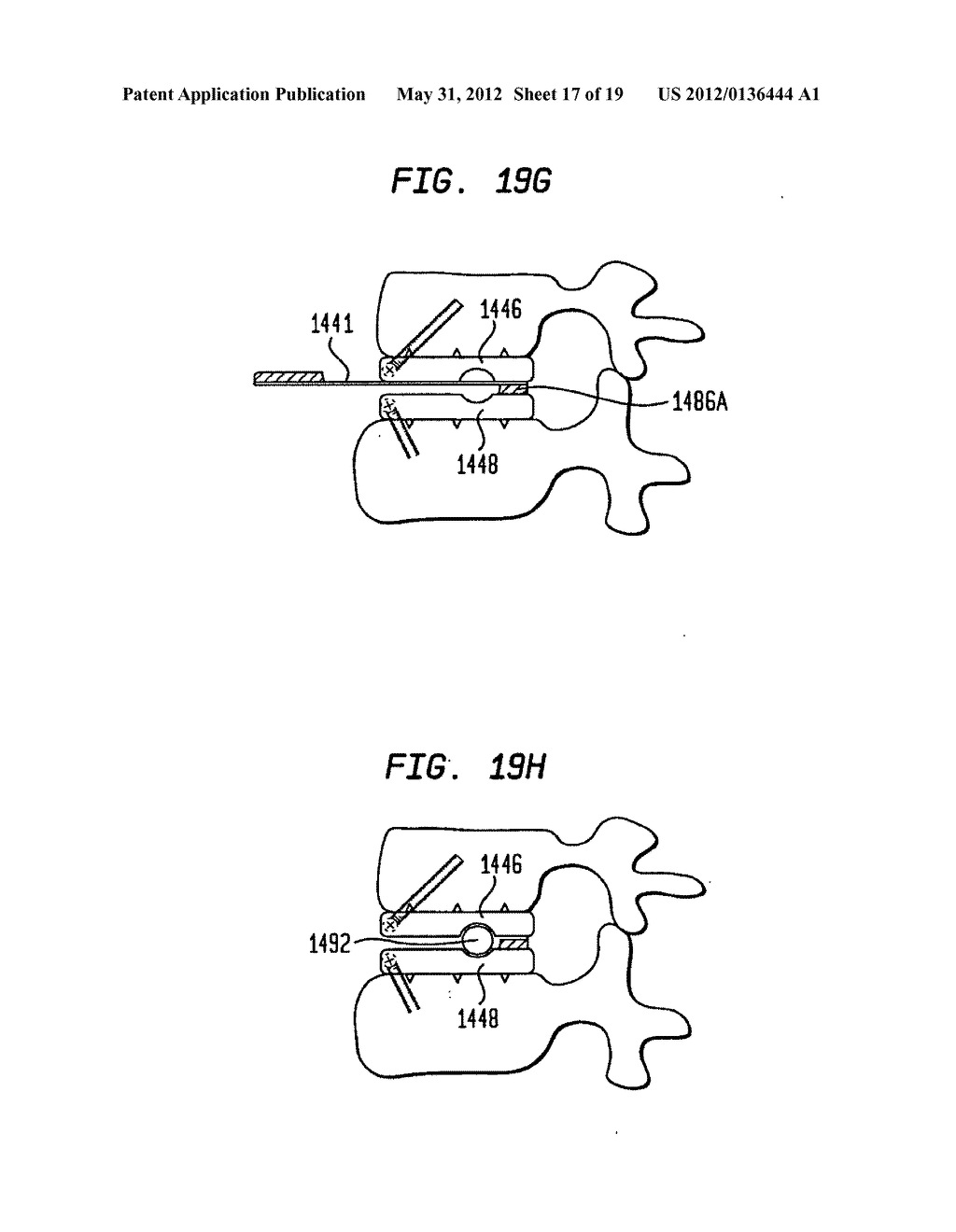 TWO-COMPONENT ARTIFICIAL DISC REPLACEMENTS - diagram, schematic, and image 18