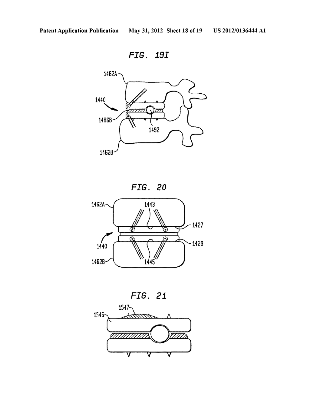 TWO-COMPONENT ARTIFICIAL DISC REPLACEMENTS - diagram, schematic, and image 19