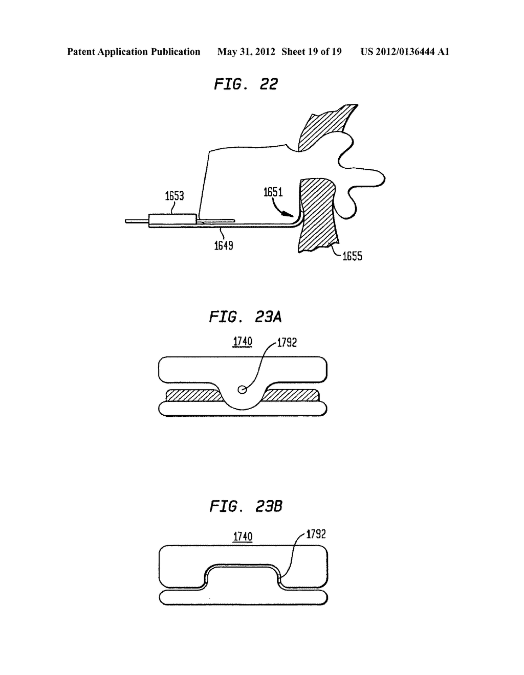 TWO-COMPONENT ARTIFICIAL DISC REPLACEMENTS - diagram, schematic, and image 20