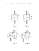 POSTERIOR SPINAL ARTHROPLASTY SYSTEM diagram and image