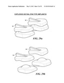 POSTERIOR SPINAL ARTHROPLASTY SYSTEM diagram and image