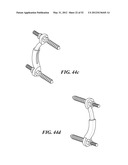 POSTERIOR SPINAL ARTHROPLASTY SYSTEM diagram and image