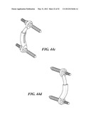 SPINAL PROSTHESIS AND FACET JOINT PROSTHESIS diagram and image