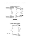 SPINAL PROSTHESIS AND FACET JOINT PROSTHESIS diagram and image